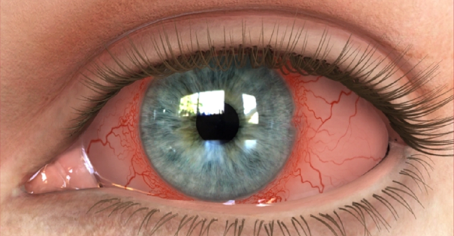 Thyroid Eye Disease and Oral Health inblog